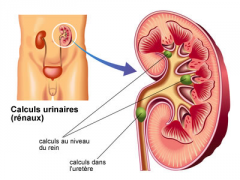 calculs-urinaires-infographie.png