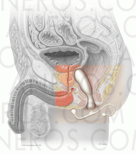 a prostatitis alatt fut