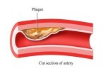 Cholesterol_artere.jpg